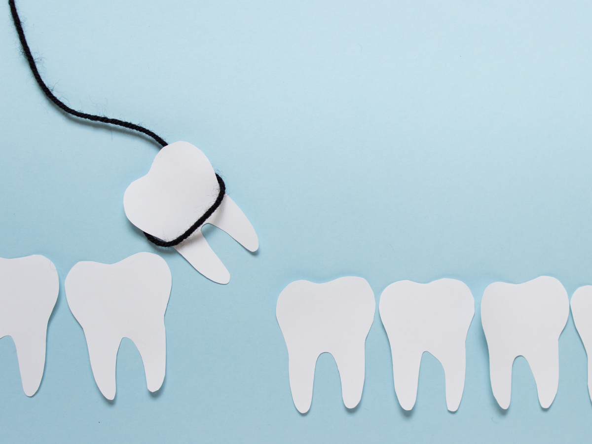 Graphic a tooth extraction in Anacortes, WA